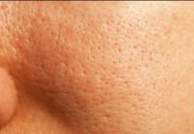 The Anemia Will Disappear And You Will Have Skin Without Large Pores Using Quince