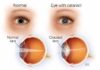 Return Your Vision And Cure Cataract Without Operation With These Remedies